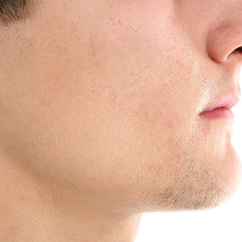 A patient with clear skin and acne removed after the laser acne treatment at AKJ Skin & Laser Clinic, Chennai.