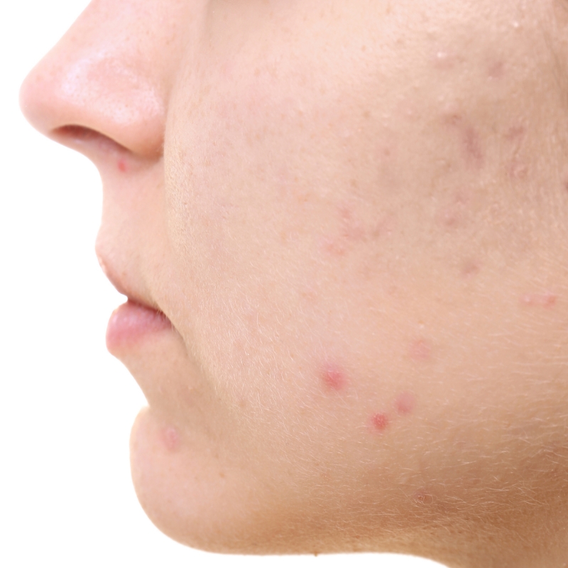 A patient with an acne-affected face before the laser acne treatment at AKJ Skin & Laser Clinic, Chennai.