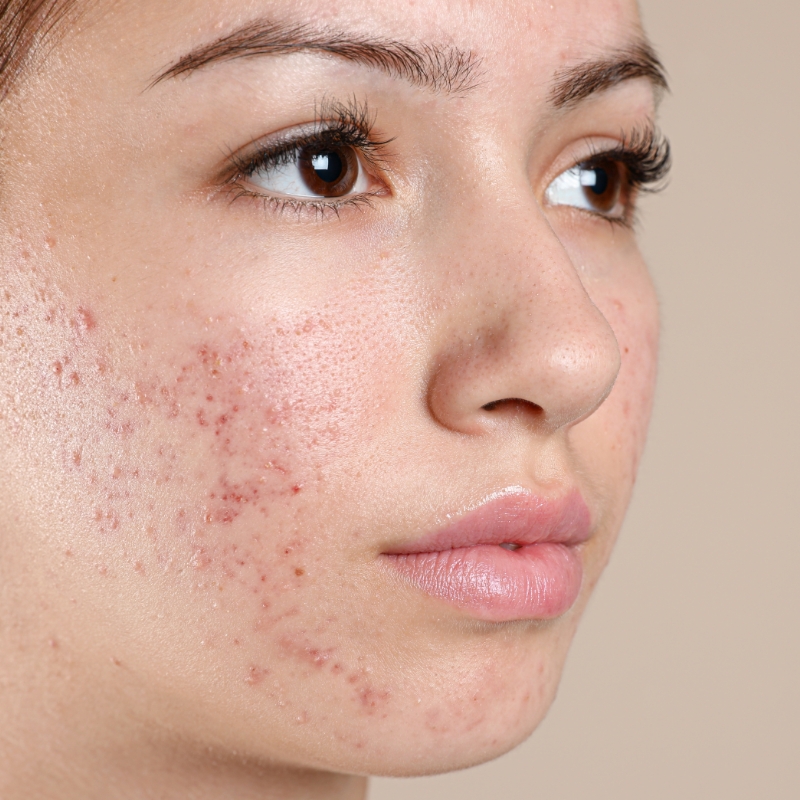 A female patient with acne and scars all over her face before the laser acne treatment at AKJ Skin & Laser Clinic, Chennai.