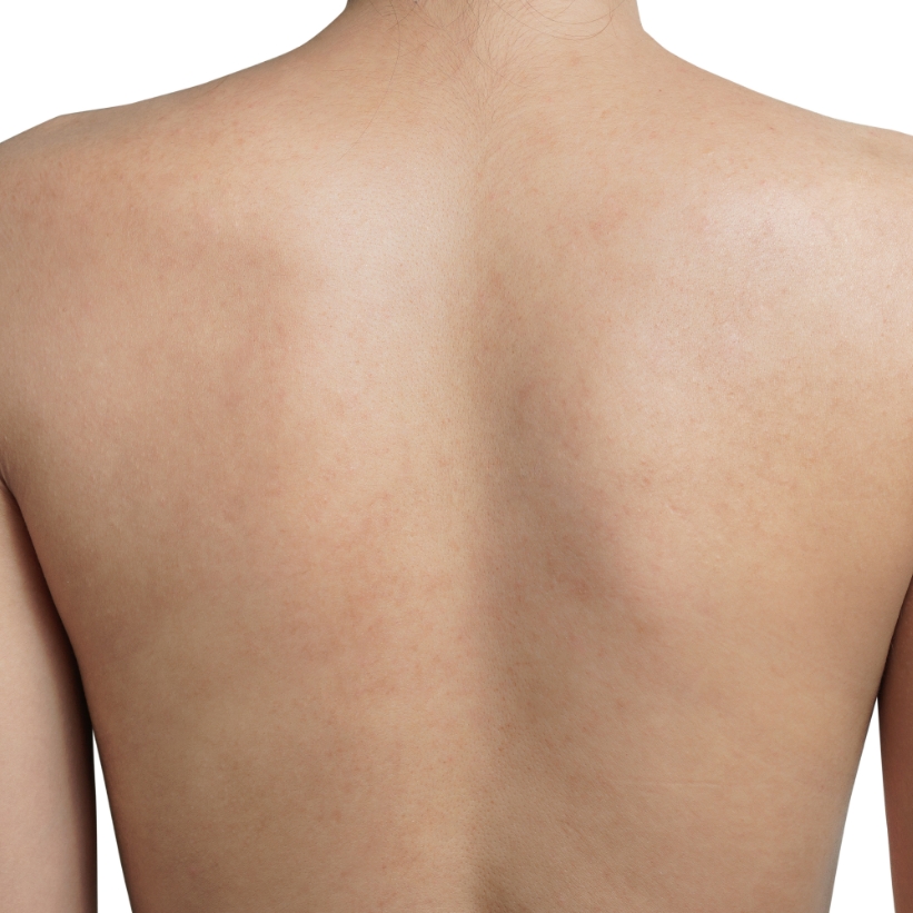 The clear scar less back of a patient after the scar removal treatment at AKJ Skin & Laser Centre, Chennai.