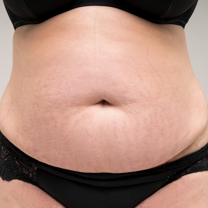 A patient showing diminished stretch marks after the laser stretch mark removal treatment at AKJ Skin & Laser Clinic, Chennai.