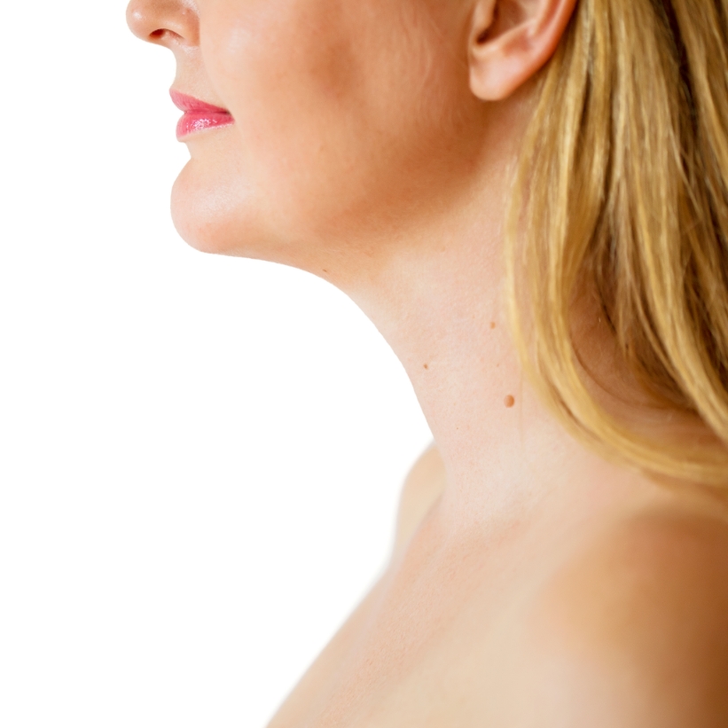 A female patient with a reduced double chin after the anti-ageing treatment at the AKJ Skin and Laser Centre, Chennai.