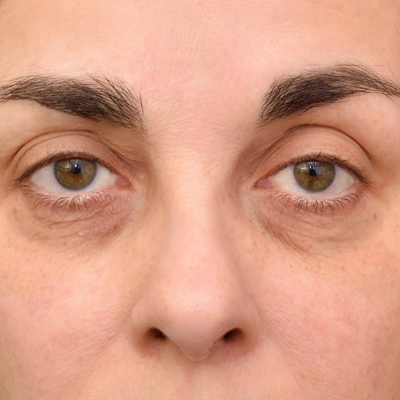 A male patient with wrinkles and age lines before the AKJ Skin and Laser Centre's Anti-Ageing Programme.