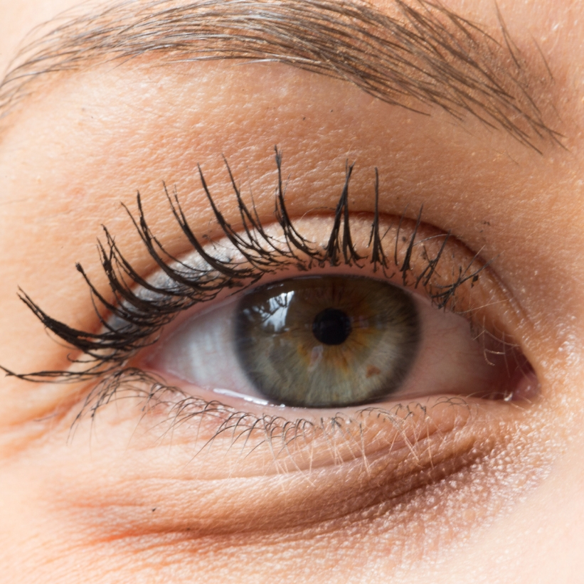 A patient with dark circles and age lines around the eye before the AKJ Skin and Laser Centre's Anti-Ageing Programme.
