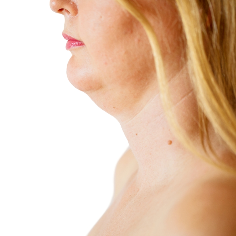 A female patient with a double chin before the anti-ageing treatment at the AKJ Skin and Laser Centre, Chennai.