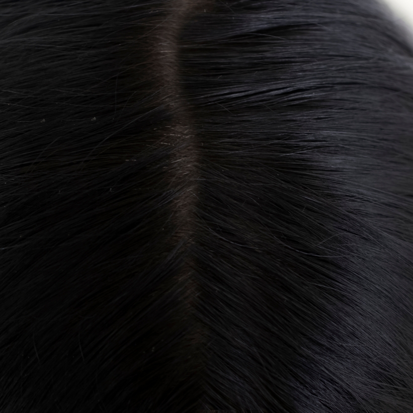 A patient showing the dense hair covering the scalp after the laser anti-hair fall treatment at AKJ Skin & Laser Clinic, Chennai.