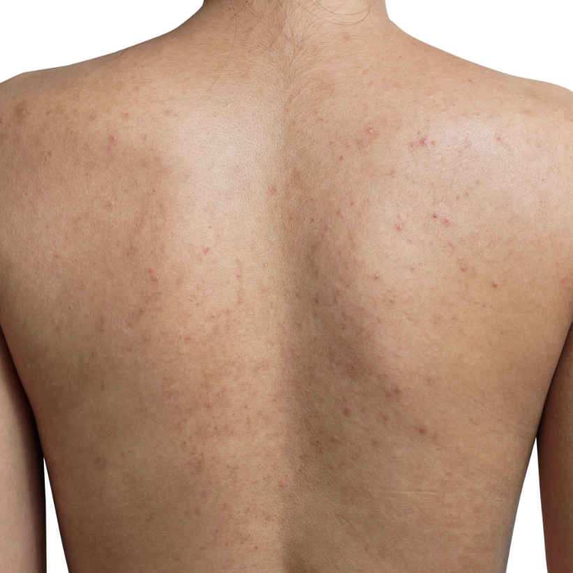Visible acne scars on the back of a patient before the scar removal treatment at AKJ Skin & Laser Centre, Chennai.