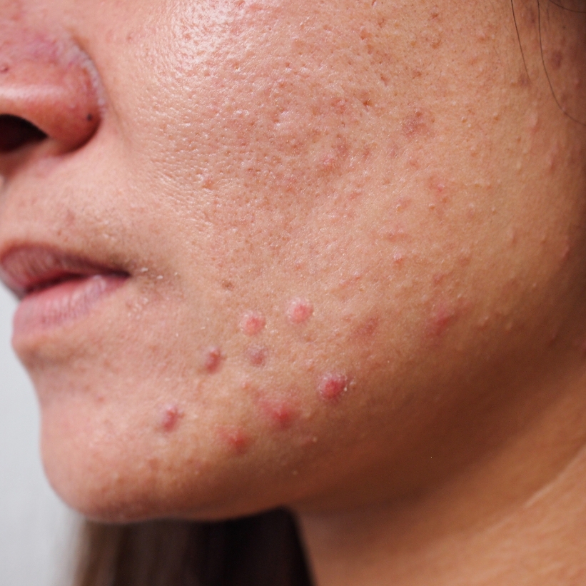A young lady with skin problems like acne before undergoing treatment at AKJ Skin & Laser Centre, Chennai.