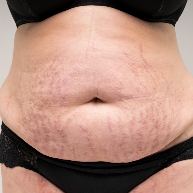 A patient showing stretch marks before the laser stretch mark removal treatment at AKJ Skin & Laser Clinic, Chennai.