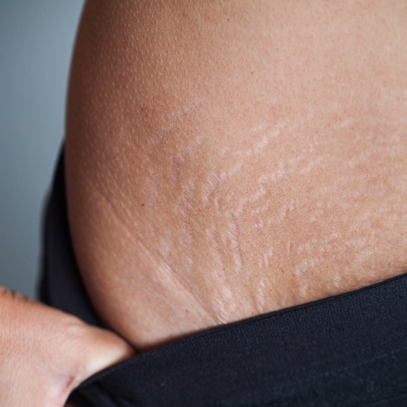 A patient showing stretch marks before the laser stretch mark removal treatment at AKJ Skin & Laser Clinic, Chennai.