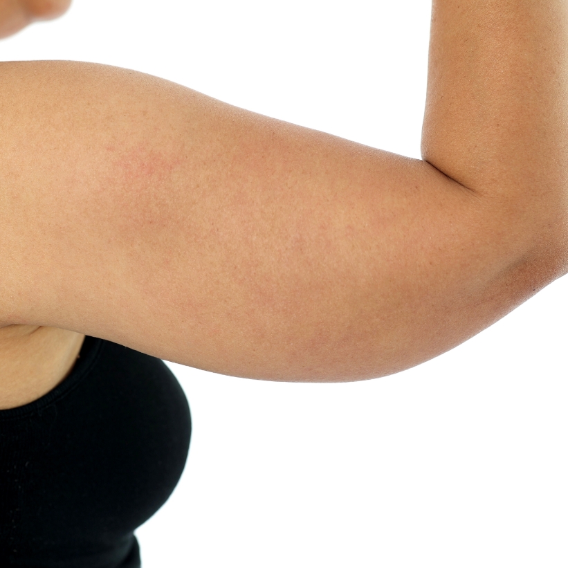 A female patient is showing her saggy arms before undergoing a fat reduction procedure at AKJ Skin & Laser Clinic, Chennai.