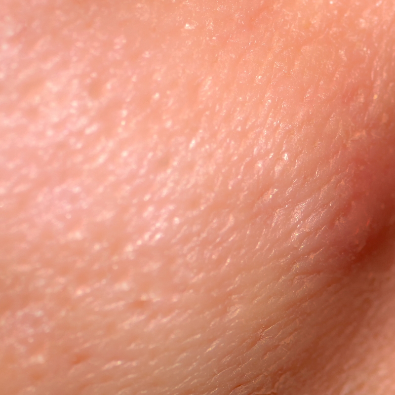 A close-up shot of the clear skin of a patient after the laser acne scar treatment at AKJ Skin & Laser Centre, Chennai.