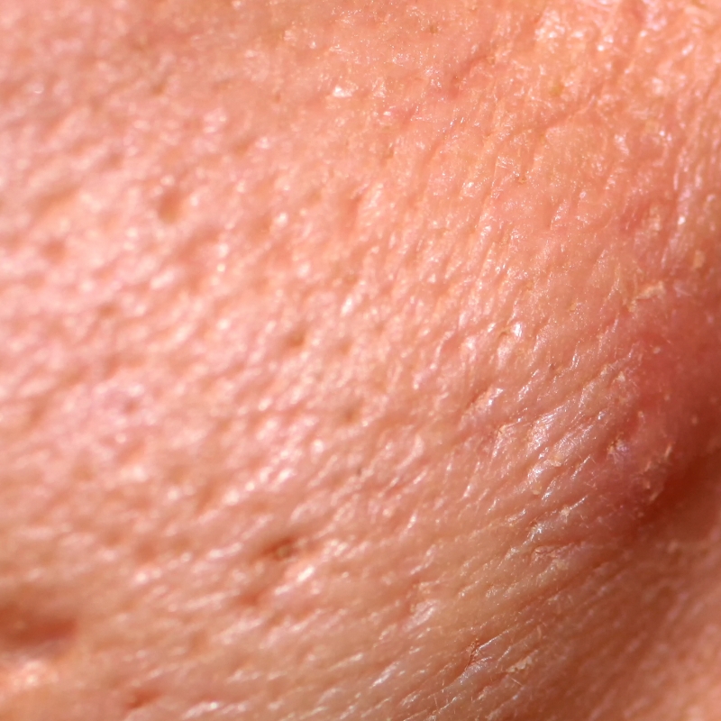 A close-up shot of the skin of a patient before the laser acne scar treatment at AKJ Skin & Laser Centre, Chennai.