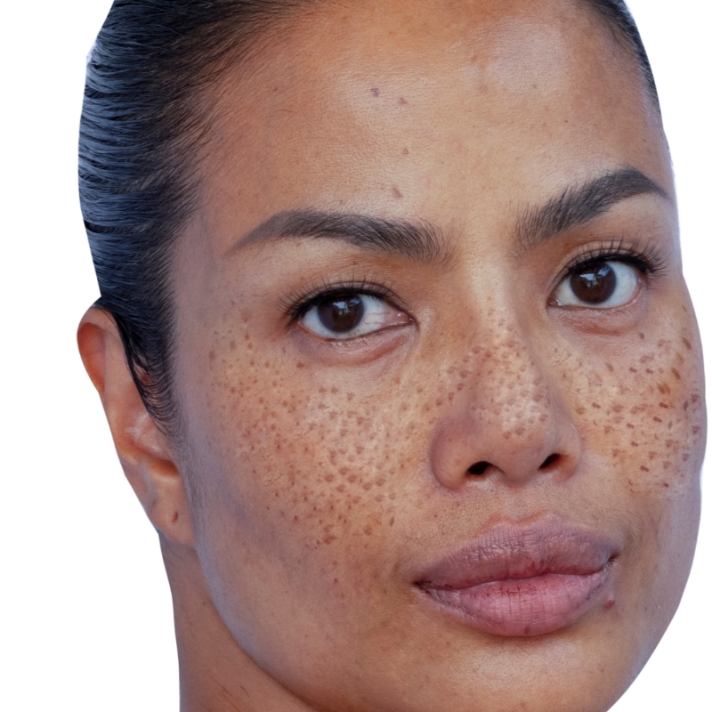A female patient with acne scars on the face before the laser acne scar treatment at AKJ Skin & Laser Centre, Chennai.