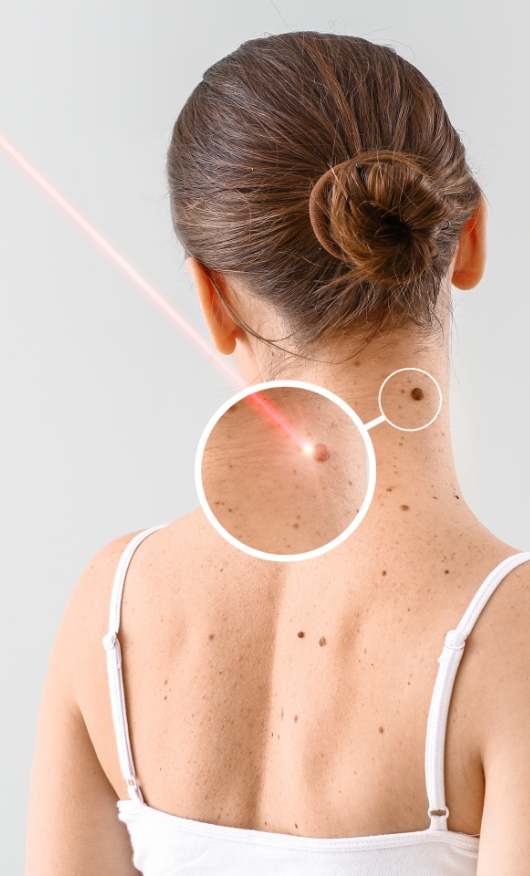 The image illustrates the laser treatment for skin lesions.