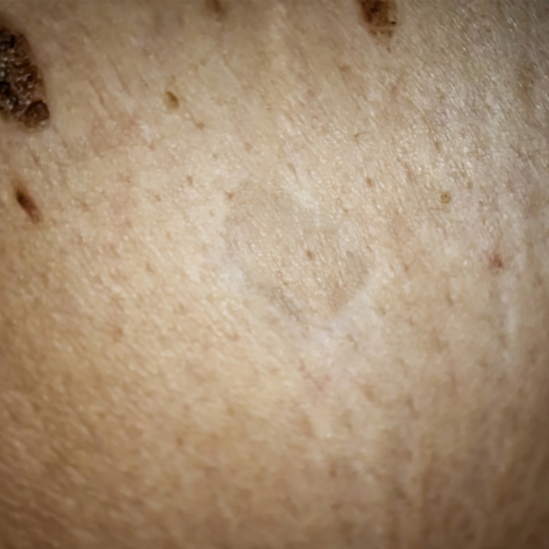The big skin lesion is completely removed after the laser skin lesions removal treatment.