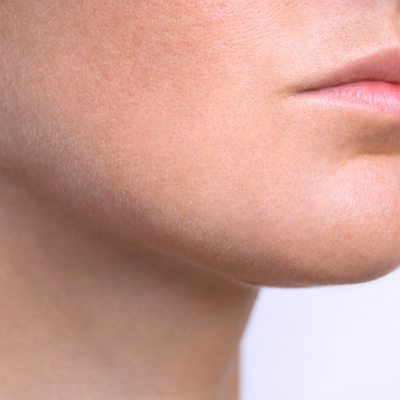 The clear skin of a female patient after the laser skin lesions removal treatment.