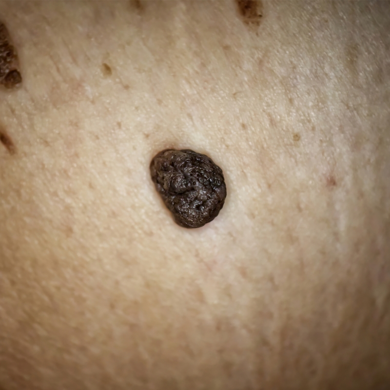 A very big skin lesion on a patient before the laser skin lesions removal treatment.