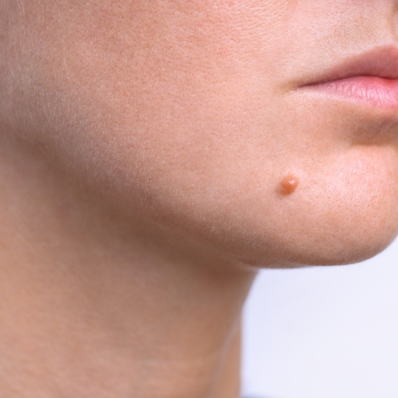 A skin lesion is seen on the chin of a female patient before the laser skin lesions removal treatment.