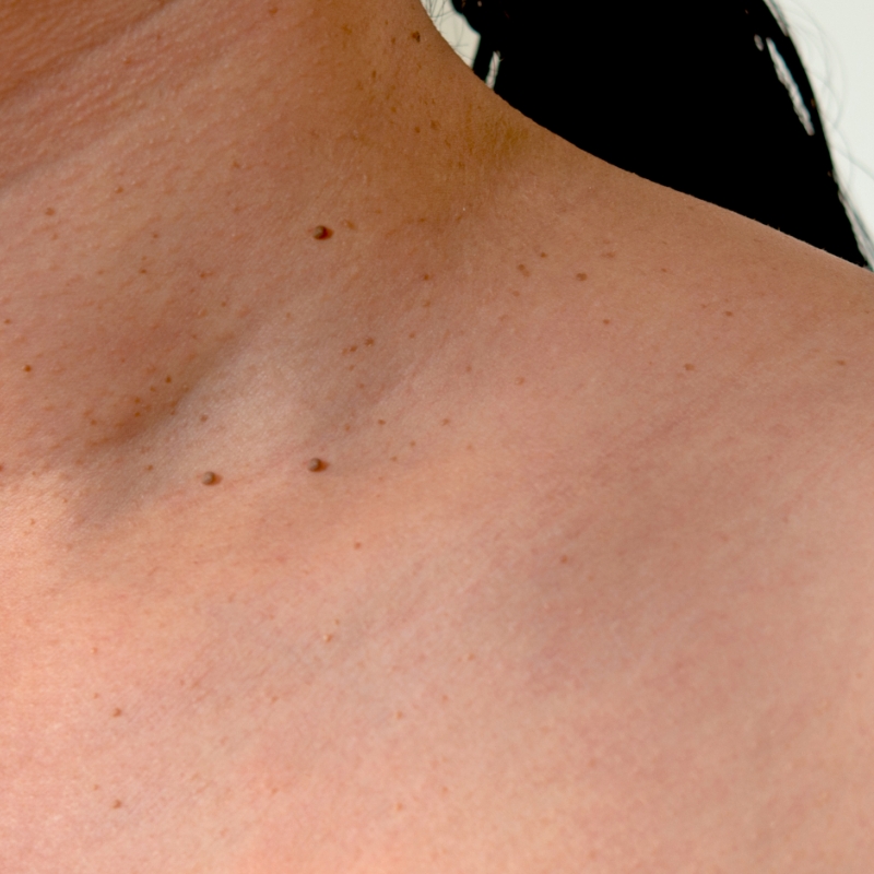 Skin lesions are seen on the neck region of a patient before the laser skin lesions removal treatment at AKJ Skin & Laser Clinic, Chennai.