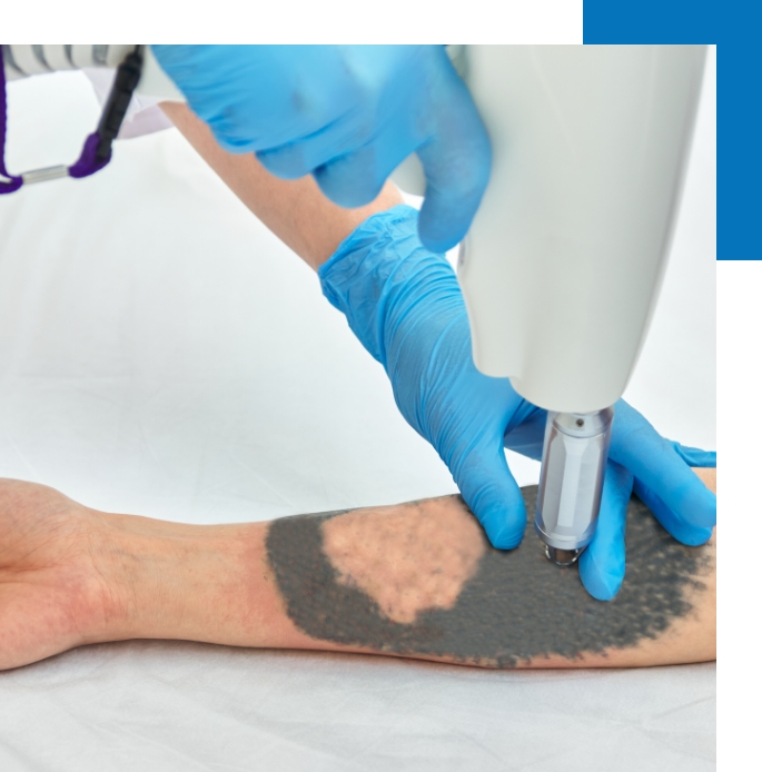 A tattoo is removed from the arm of a patient.