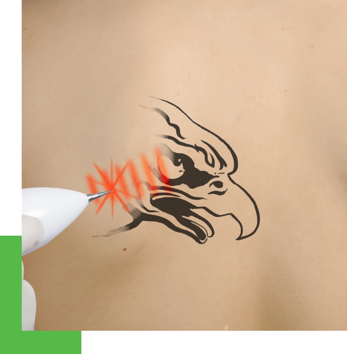 A tattoo is removed for a patient with laser.