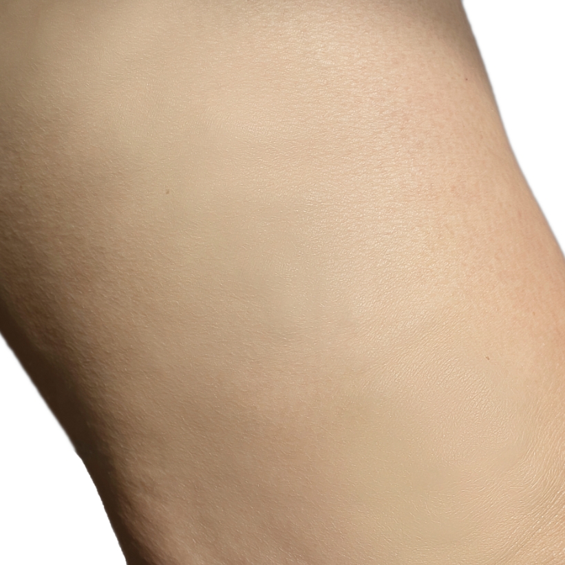 A patient with smooth skin after a laser varicose vein treatment.
