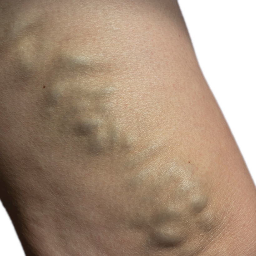A patient with visible varicose veins before a laser varicose vein treatment.
