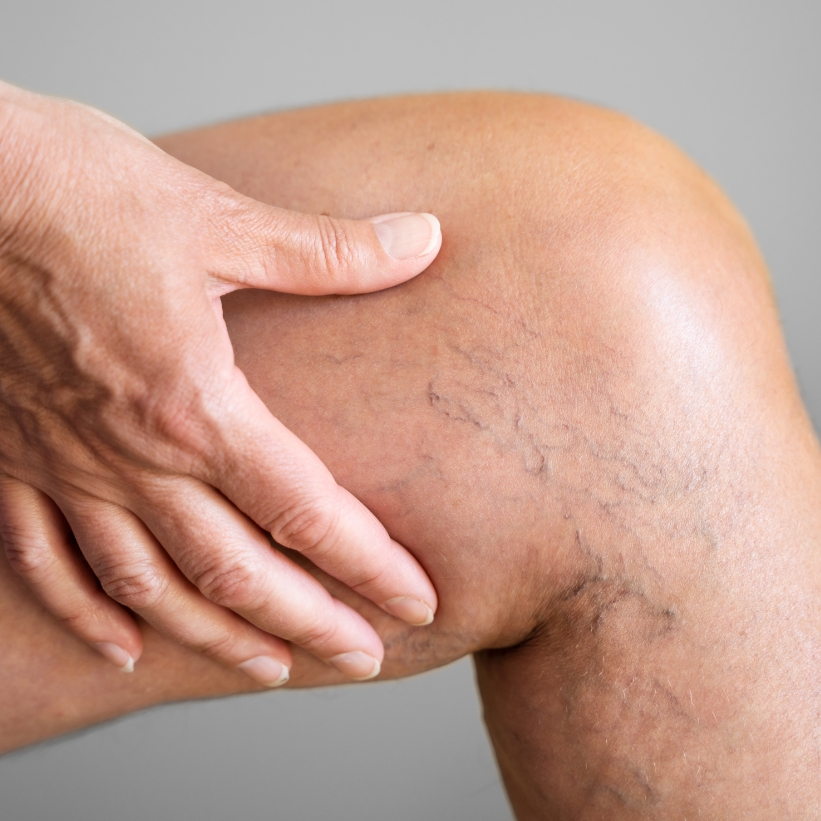 A patient with visible varicose veins on the legs before a laser varicose vein treatment.