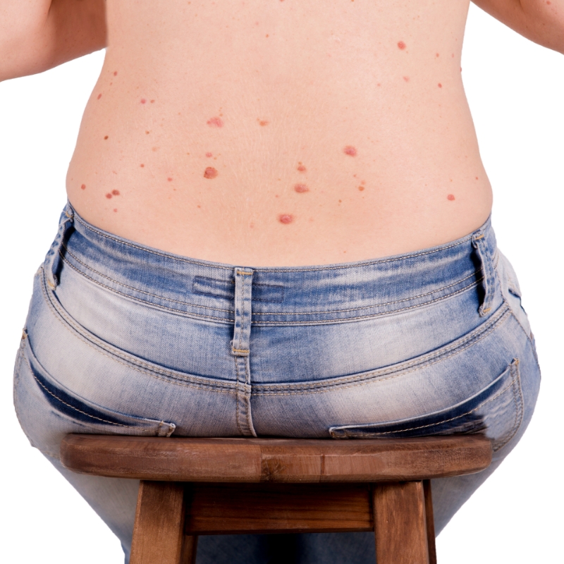 A patient with birthmark marks on his back before birthmark removal procedure at AKJ Skin and Laser Centre, Chennai.
