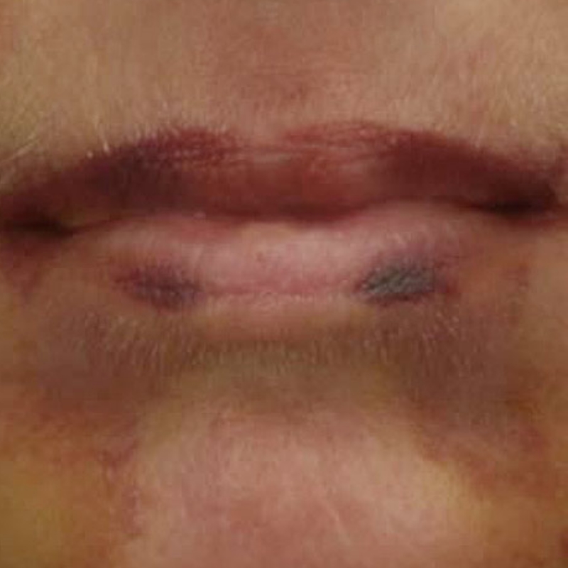 A patient with diminished port wine stains around the mouth after Port Wine Stain Removal Procedure at AKJ Skin and Laser Centre, Chennai.