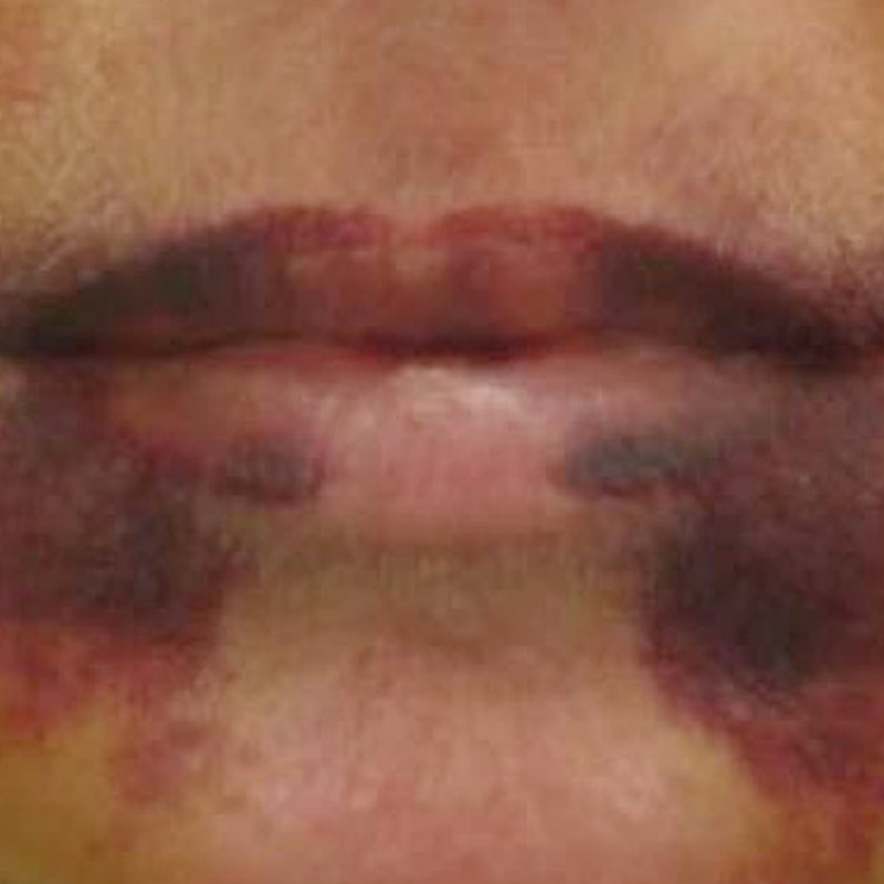 A patient with port wine stains around the mouth area before Port Wine Stain Removal Procedure at AKJ Skin and Laser Centre, Chennai.