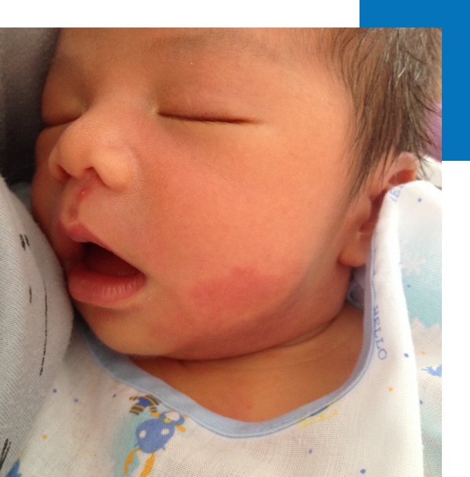 An infant with port wine stains on the cheek.