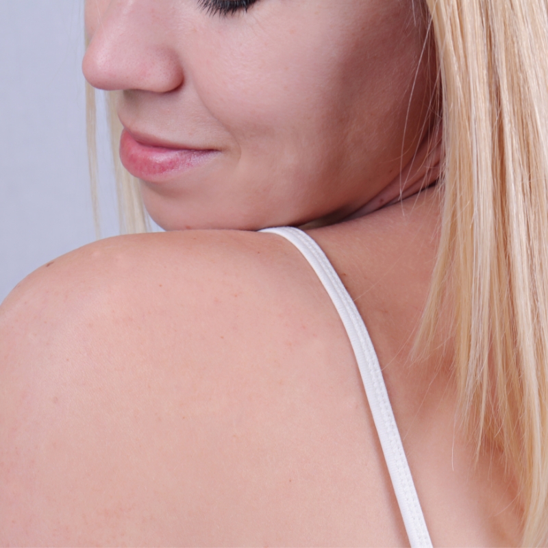 A female patient with clear shoulders and back after the birthmark removal procedure at AKJ Skin and Laser Centre, Chennai.