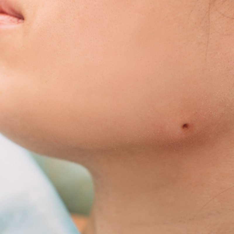 A patient with diminished birthmarks on the face after a birthmark removal procedure at AKJ Skin and Laser Centre, Chennai.