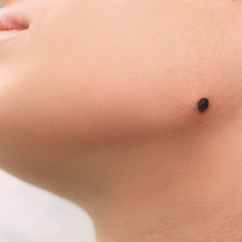 A patient with a birthmark on the face before birthmark removal procedure at AKJ Skin and Laser Centre, Chennai.