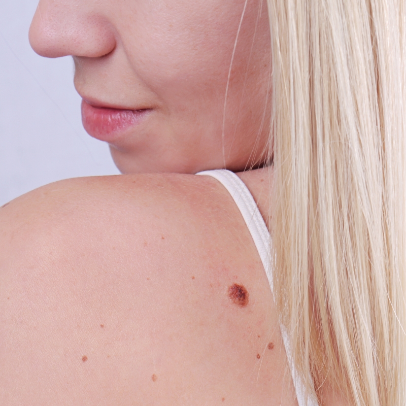 A female patient with birthmark marks on her shoulders and back before a birthmark removal procedure at AKJ Skin and Laser Centre, Chennai.