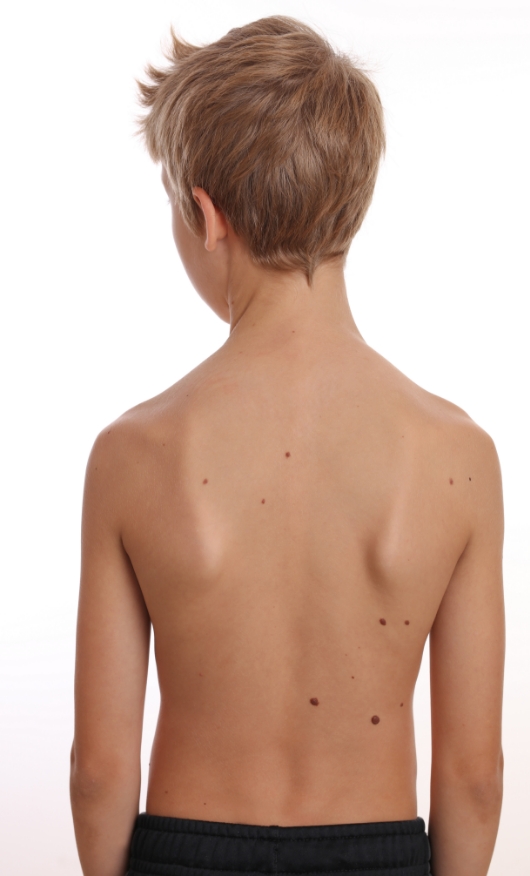 Skin tags are seen on the back of a small boy.