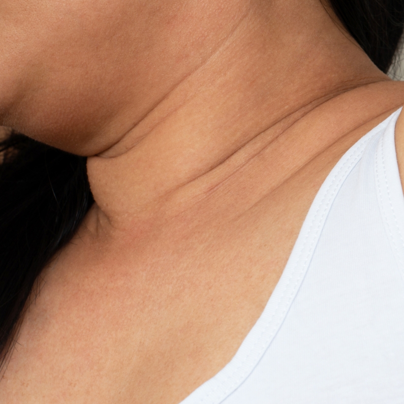 Clear skin with skin tags completely removed on the neck region of a patient after the laser skin tag removal treatment at AKJ Skin & Laser Clinic, Chennai.