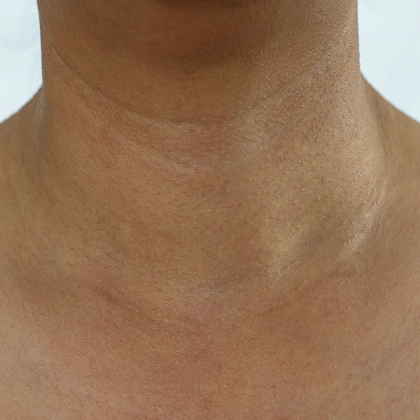 A clear neck of a patient with all the skin tags removed after the laser skin tag removal treatment at AKJ Skin & Laser Clinic, Chennai.