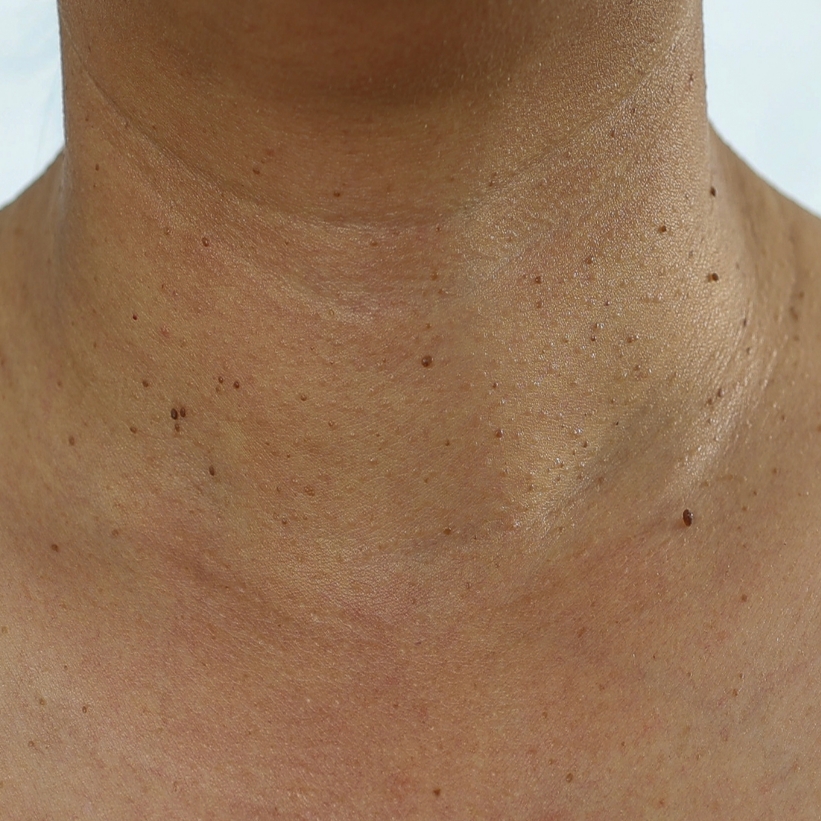A patient with skin tags on the neck region before the laser skin tag removal treatment at AKJ Skin & Laser Clinic, Chennai.