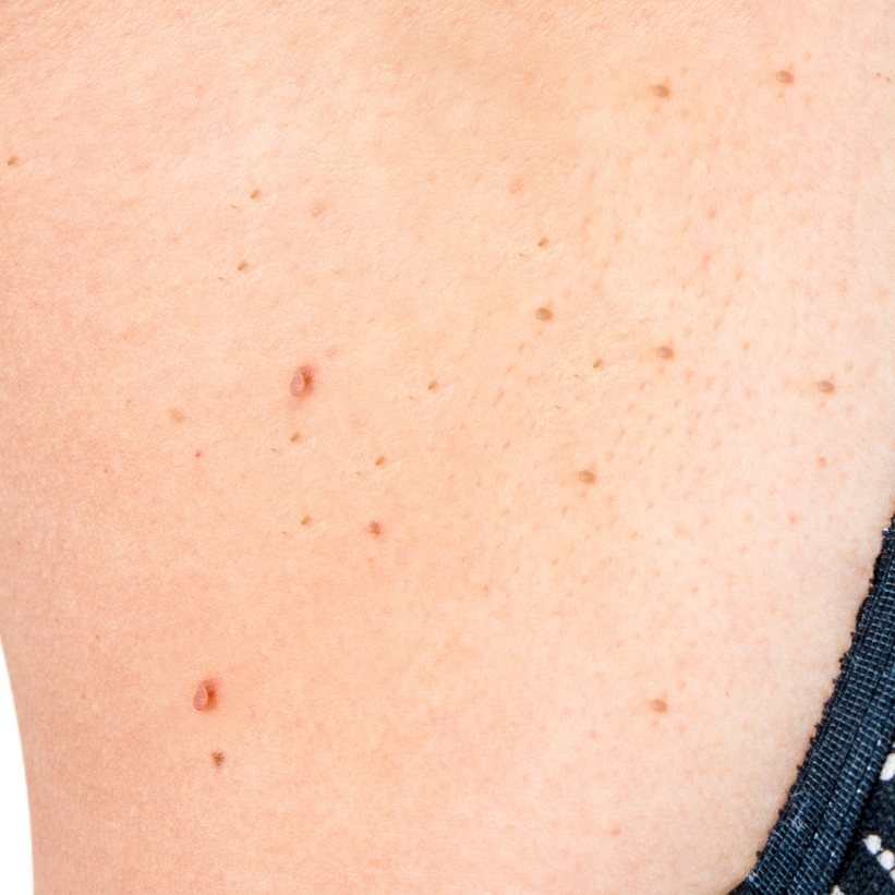 A patient shows the skin tags on the body before the laser skin tag removal treatment at AKJ Skin & Laser Clinic, Chennai.