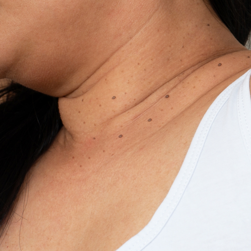 Skin tags are seen on the neck region of a patient before the laser skin tag removal treatment at AKJ Skin & Laser Clinic, Chennai.