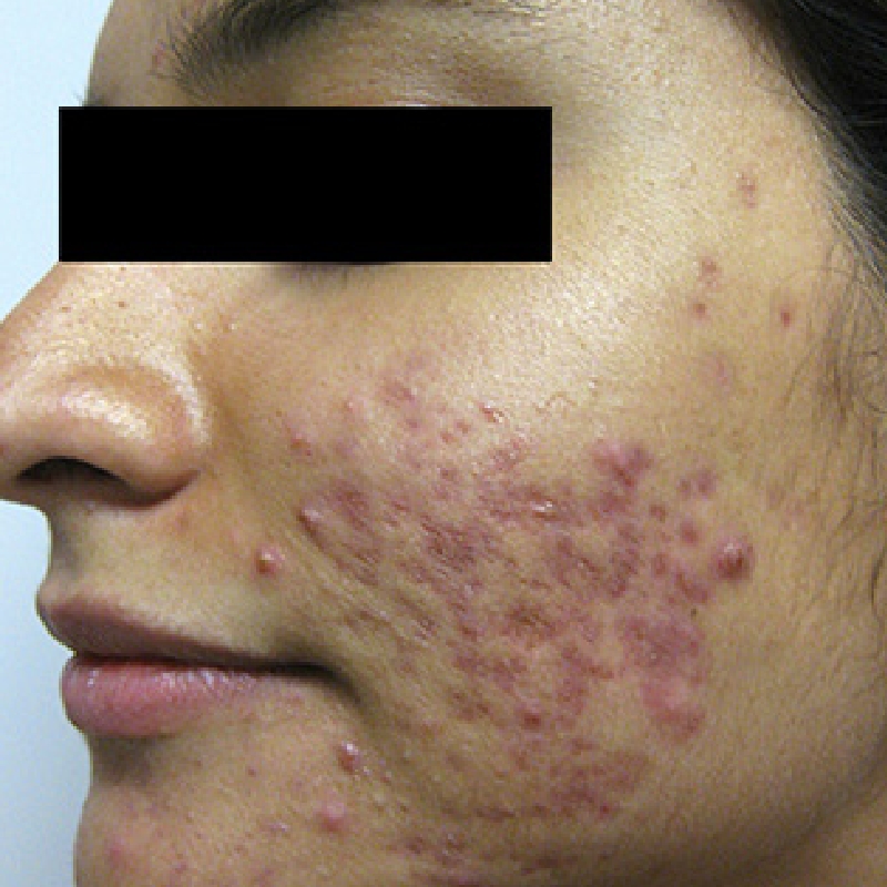 A female patient with numerous acne scars on the face before the laser acne scar treatment at AKJ Skin & Laser Centre, Chennai.