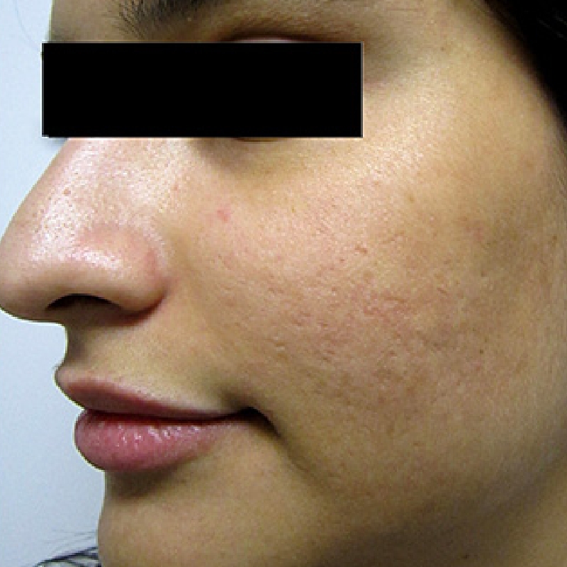 A female patient with a clear face after the laser acne scar treatment at AKJ Skin & Laser Centre, Chennai.