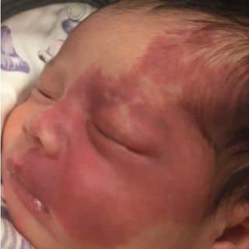 A newborn with port wine stains all over the face before Port Wine Stain Removal Procedure at AKJ Skin and Laser Centre, Chennai.