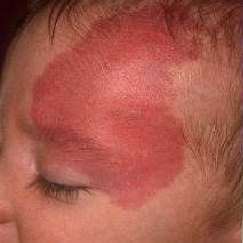 A small boy with port wine stains on his face before Port Wine Stain Removal Procedure at AKJ Skin and Laser Centre, Chennai.