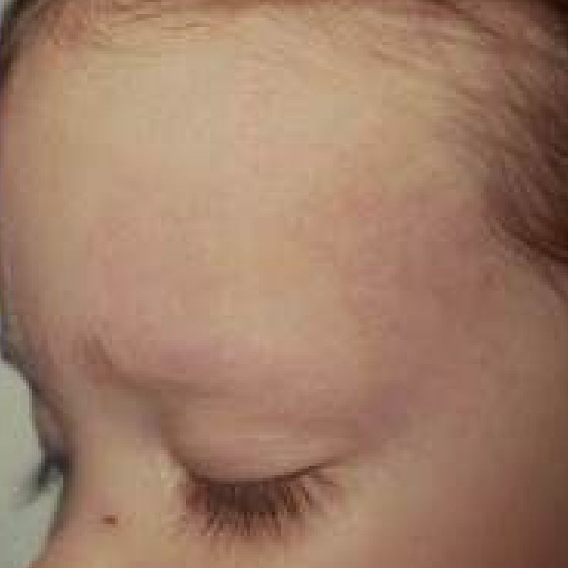 A small boy with a clear face after Port Wine Stain Removal Procedure at AKJ Skin and Laser Centre, Chennai.