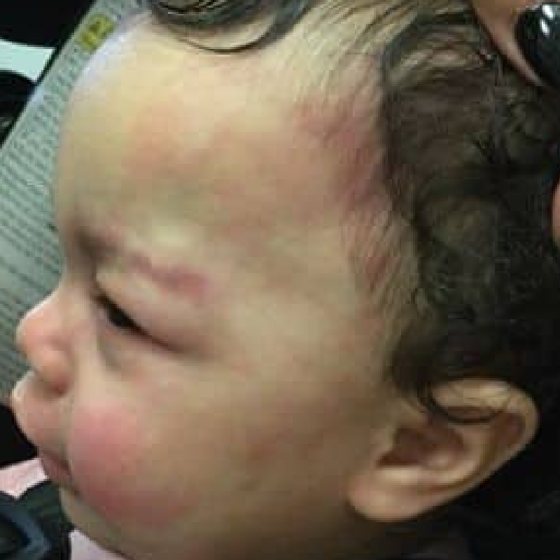 An infant with diminished port wine stains on the face after the port wine stain removal procedure at AKJ Skin and Laser Centre, Chennai.