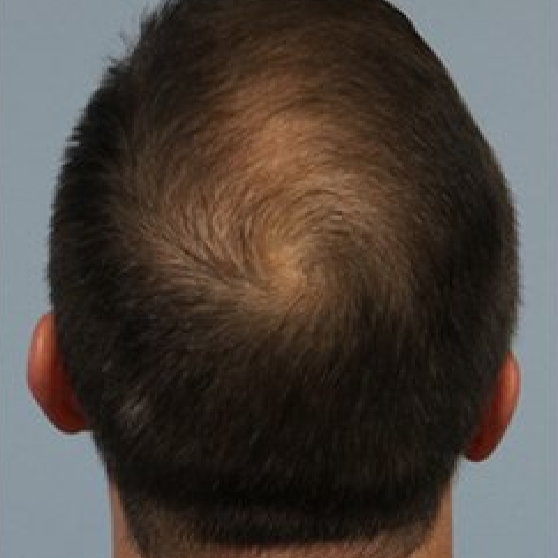 Top view of a men's head with newly grown hairs and reduced baldness after hair transplantation surgery.
